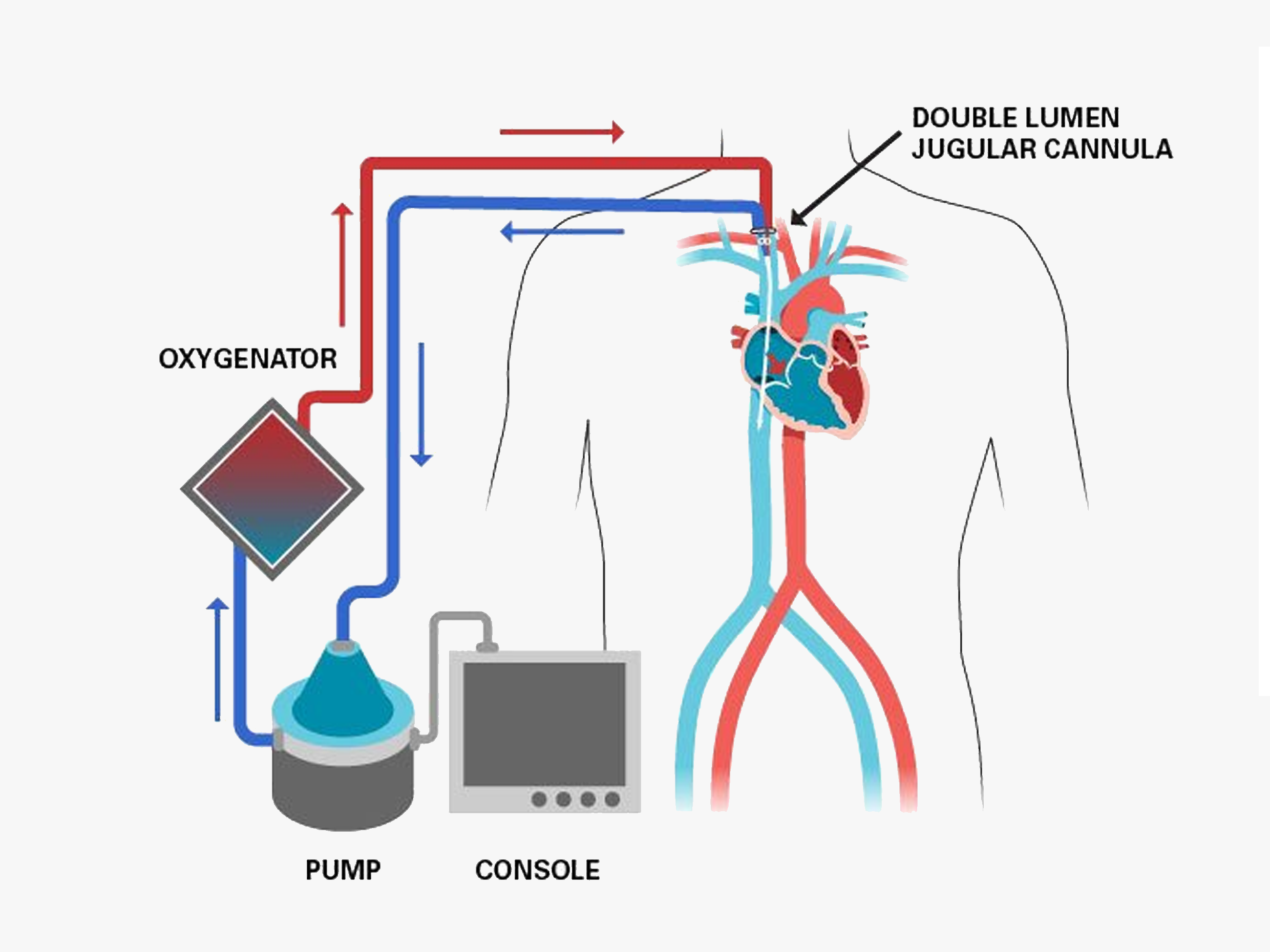 Disposable ECMO Set